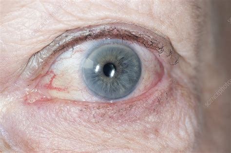 Bulging Eye In Hyperthyroidism Stock Image C0111798 Science