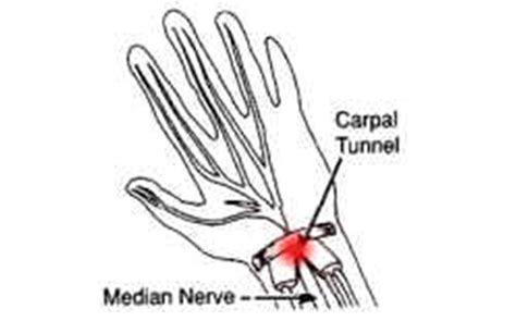 Carpal Tunnel Syndrome Causes And Treatment