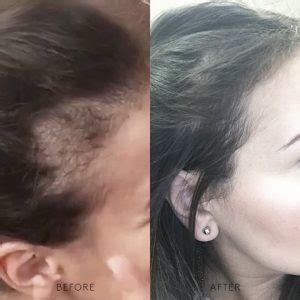 Depending on the cause, men's hair loss can come suddenly or take its sweet time. What's the solution to sudden hair loss?..