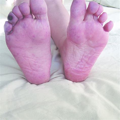 Blue Toe Syndrome Lesion Of The 4 Th Toe Of Right Foot Is Demonstrated