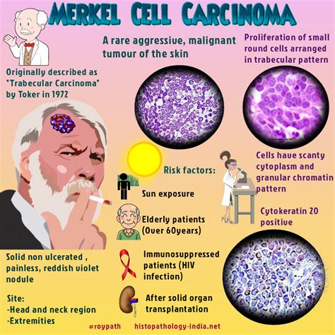 It's a type of skin cancer that occurs when cells in the skin, known as merkel cells, grow uncontrollably. Pathology of Merkel Cell Carcinoma #roypath | Merkel ...