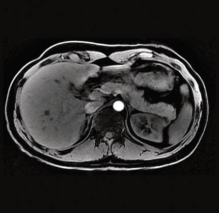 Abdominal MRI - Insight Medical Imaging