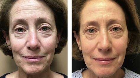 My Experience With Fraxel Restore Dual Laser Skin Resurfacing Youtube