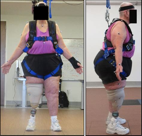 Quantitative Assessment Of Walker Assisted Gait In Transtibial Amputees