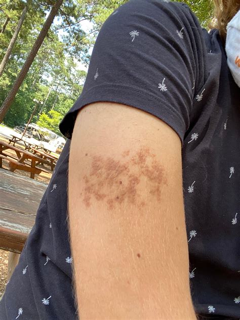 Weird Skin Patch That Ive Had For 5 Ish Years Diagnoseme