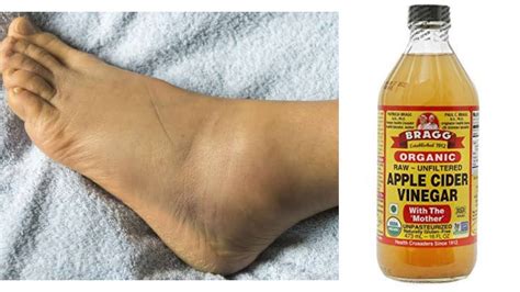 How To Reduce Swollen Feet Legs And Ankle Using Apple Cider Vinegar