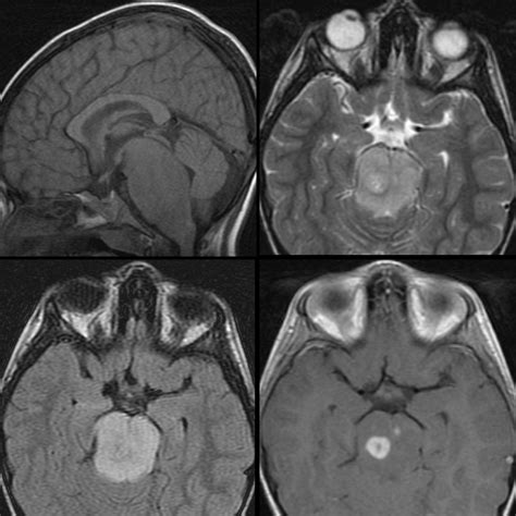 Brainstem Glioma Pediatric Radiology Reference Article Pediatric