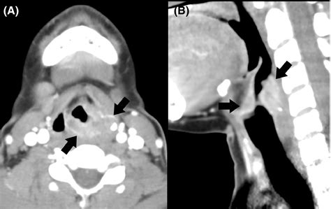Laryngeal Tuberculosis Mimicking Malignancy A Case Report Eltilib