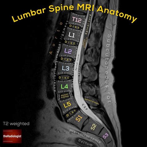 Sagittal T Weighted Image Of An Mri Of The Lumbar Spine Lumbar Spine Mri Anatomy This