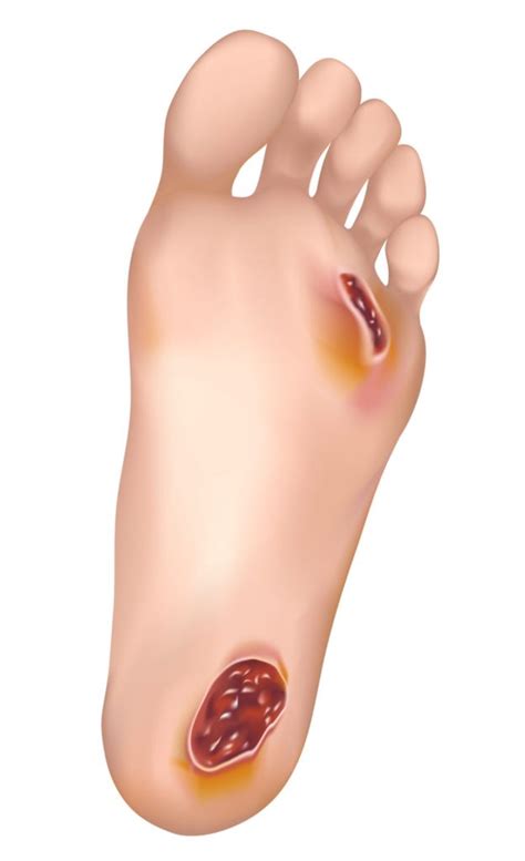 An ulcer is a discontinuation in the bodily membrane, so technically, a paper cut on the finger is a form of ulcer. Diabetic Foot Ulcer Causes, Symptoms, Treatment in Dallas ...