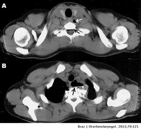 Esophageal Perforation In Closed Neck Trauma Brazilian Journal Of