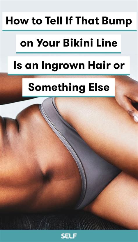 They also may have a yellow tint to them. How to Tell If That Bump on Your Bikini Line Is an Ingrown ...