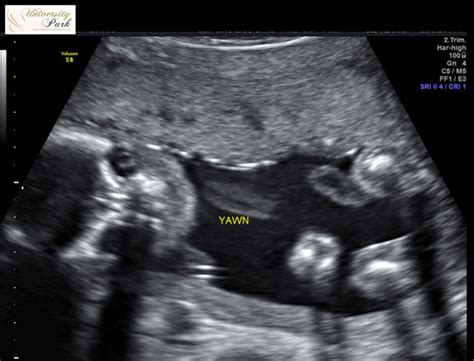 Animated  20 Week Anatomy Ultrasound Babycenter