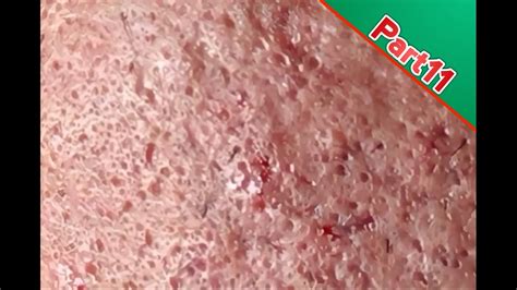 Part11 Awesome Blackheads On The Forehead Top Skin Care Youtube