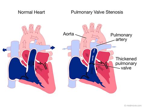 Ross Procedure Valvular Stenosis Echocardiogram