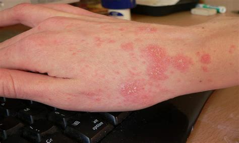 We did not find results for: Scabies rash Look Like & Causes10