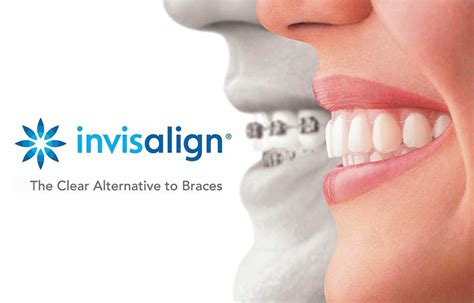 Invisalign Logo The Denver Dentists And Implant Center
