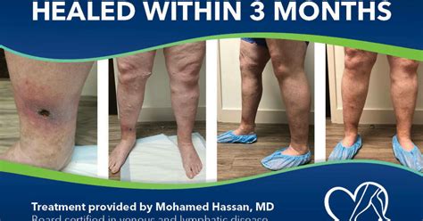 Why You Should Never Ignore Your Varicose Veins A Patients Story