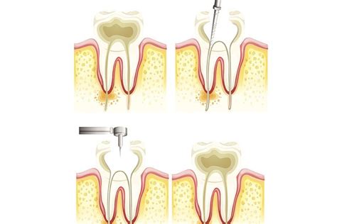 In the following sections we will be discussing the factors that decide the. Root Canal Treatment Langley BC - Endodontic Treatment