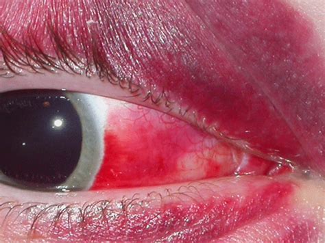 Broken blood vessels or spider veins are enlarged blood vessels under the skin. What Causes Broken or Burst Blood Vessels in the Eyes ...