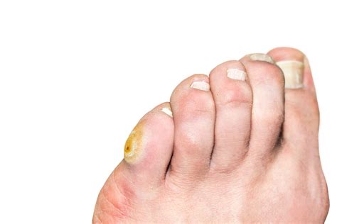 Corn On The Pinky Toe Calluses Causes And Treatments Canyon Oaks