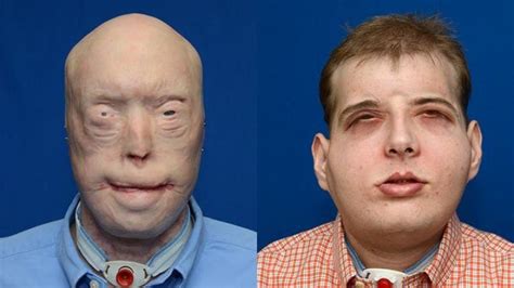 Médicos De Nueva York Practican Complejo Trasplante De Cara