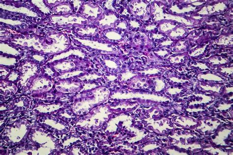 Chronic Nephritis Light Micrograph Stock Image Image Of Kidney