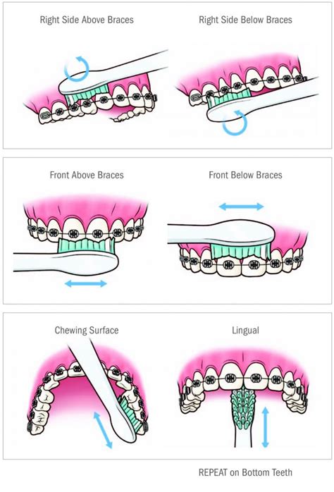 Brushing Technique For Patients With Braces Uttam Dental Clinic