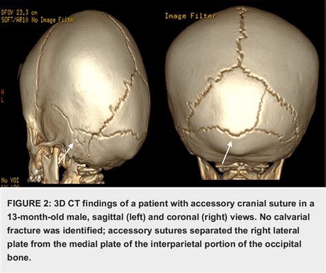 Figure 2 From Imaging Findings In Pediatric Accessory Cranial Sutures