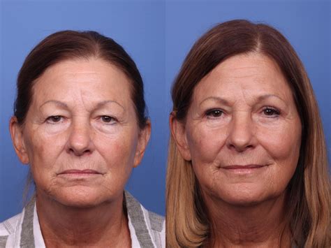 blepharoplasty before and after pictures case 433 scottsdale az hobgood facial plastic