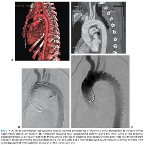 Thoracic Aortic Stent Graft Repair For Aneurysm Dissection And