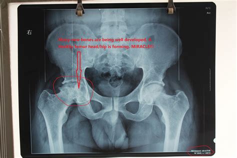 Hip Replacement Alternatives Hip Replacement Option