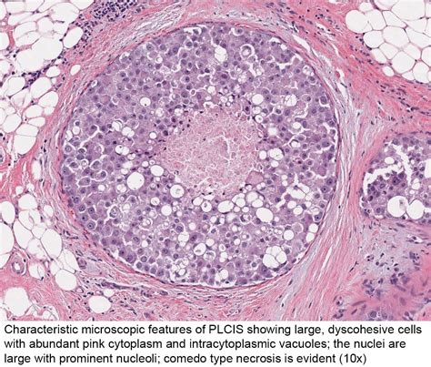 Pathology Outlines Pleomorphic Lobular Carcinoma In Situ Plcis