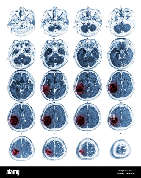 Mri Brain Show Brain Tumor At Right Parietal Lobe Stock Photo Alamy