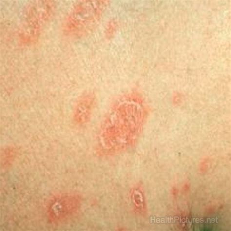 Pityriasis Rosea On Face Pictures Photos