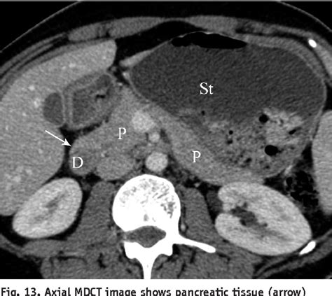 Figure 4 From Congenital Variants And Anomalies Of The Pancreas And