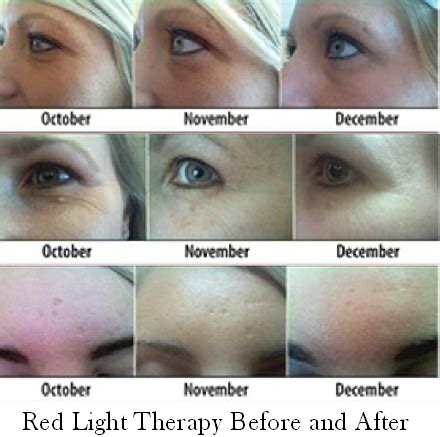 Over time, the redness tends to become ruddier and more persistent, and visible blood vessels may appear. Red & Yellow Light Therapy Seriously Fights Aging