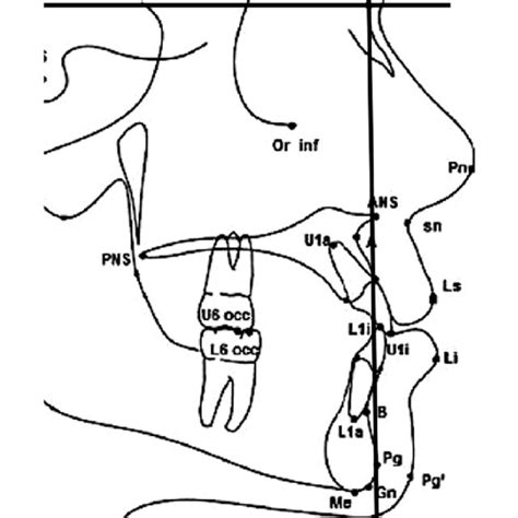 Cephalometric Landmarks And Reference Lines Download Scientific Diagram