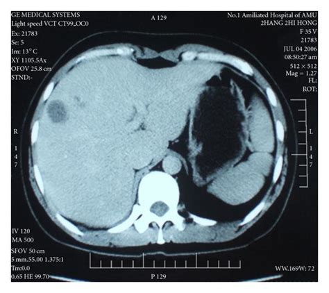 CT Showed One Low Density Lesion Under The Right Hepatic Lobe Capsule