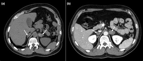 A Axial Non Contrast Computed Tomography Ct Shows Bilateral