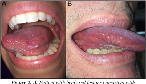 Figure 2 From Oral Cavity Squamous Cell Carcinoma An