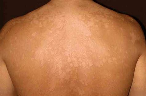 👉 Tinea Versicolor Pictures Contagious Symptoms Treatment