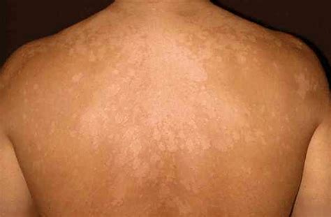 The disease is usually widespread in a tropical humid environment. Omaha Dermatology - Tinea Versicolor Treatment | Skin ...