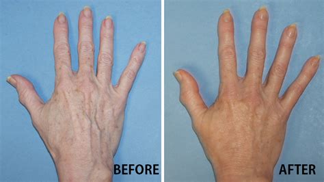 Hand Rejuvenation Art Of Plastic Surgery Fairfield Ct