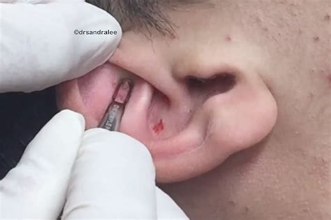 Blackhead Squeezing Video Is Disgusting But Captivating Daily Star