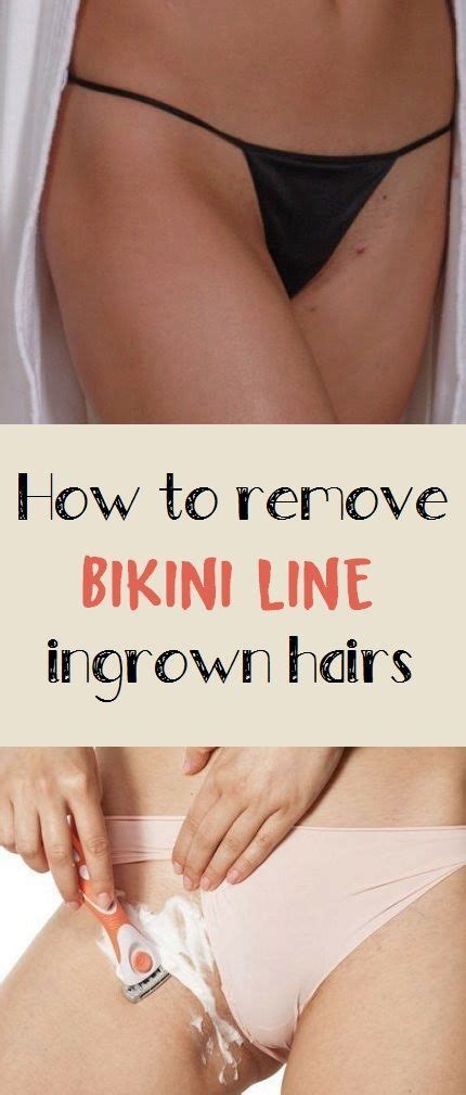 How To Remove Bikini Line Ingrown Hairs Bikini Line Ingrown Hair Ingrown Hair Ingrown Hair