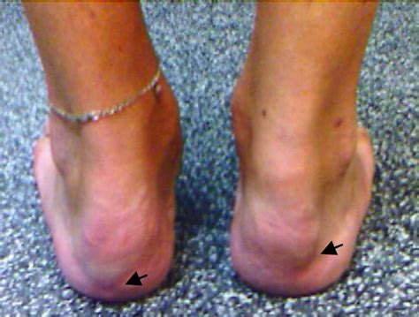 Enthesitis Of The Achilles Tendon Note Arrows Indicate Severe