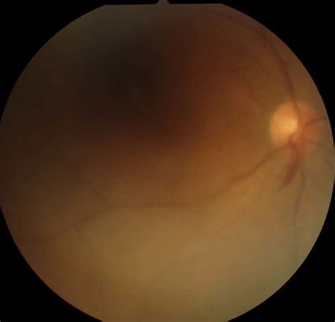 Fundus Photograph Of The Right Eye Revealed Diffuse Vitreous Opacity