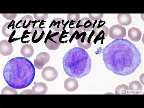 Acute Myelomonocytic Leukemia