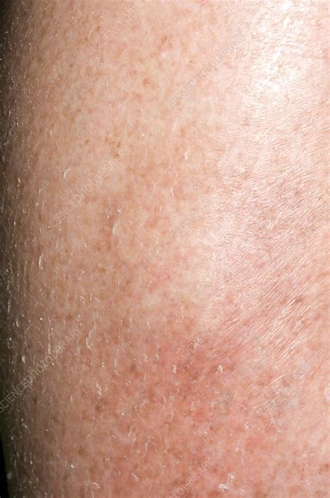 Fading Bruise On The Leg Stock Image C0041261 Science Photo Library